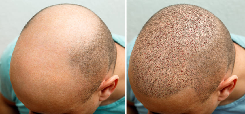 greffe-cheveux-turquie